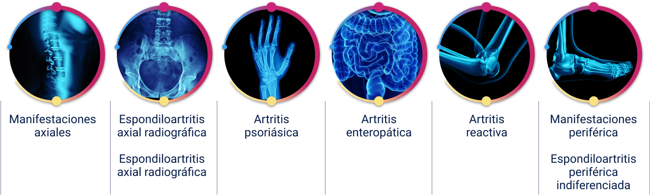 Imagen creada a partir de: Ankylosing spondylitis and axial spondyloarthritis: recent insights and impact of new classification criteria. Fabian Proft, Denis Poddubnyy. Ther Adv Musculoskelet Dis. 2018 Jun; 10(5-6): 129–139.